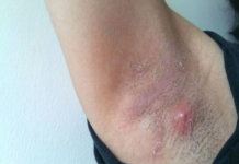 LJUDI SE NE PERU ISPOD PAZUHA KAKO TREBA: Stručnjak za higijenu savetuje čime da izlečite bubuljice i uklonite znoj