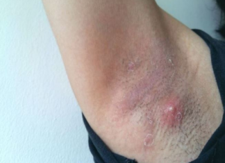 LJUDI SE NE PERU ISPOD PAZUHA KAKO TREBA: Stručnjak za higijenu savetuje čime da izlečite bubuljice i uklonite znoj