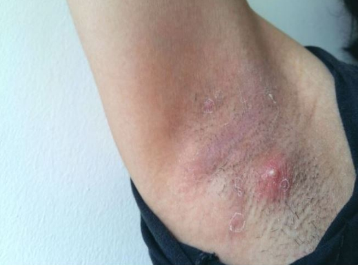 LJUDI SE NE PERU ISPOD PAZUHA KAKO TREBA: Stručnjak za higijenu savetuje čime da izlečite bubuljice i uklonite znoj