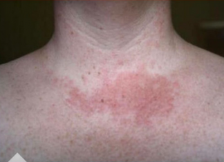 Da li primjećujete ove promjene na svom licu ili vratu: Doktor otkriva šta vam se dešava