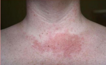 Da li primjećujete ove promjene na svom licu ili vratu: Doktor otkriva šta vam se dešava