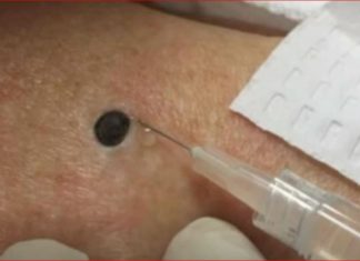 ŽENA JE GAJILA OVO NA LEĐIMA: Kada je doktorka uzela špric i bocnula, shvatit ćete zašto je SNIMAK pregledalo 33 miliona ljudi!