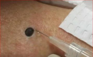ŽENA JE GAJILA OVO NA LEĐIMA: Kada je doktorka uzela špric i bocnula, shvatit ćete zašto je SNIMAK pregledalo 33 miliona ljudi!