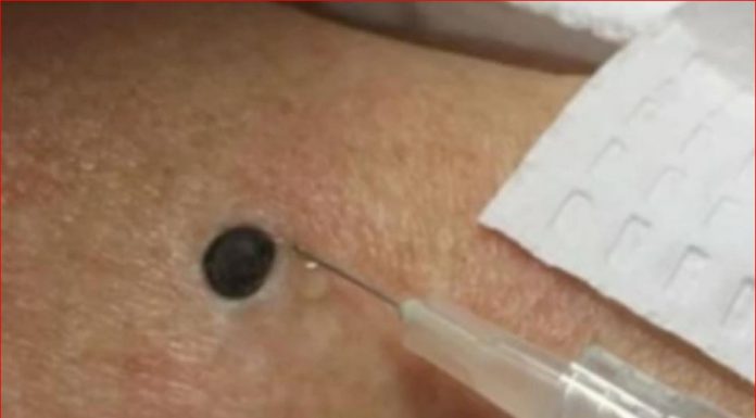 ŽENA JE GAJILA OVO NA LEĐIMA: Kada je doktorka uzela špric i bocnula, shvatit ćete zašto je SNIMAK pregledalo 33 miliona ljudi!