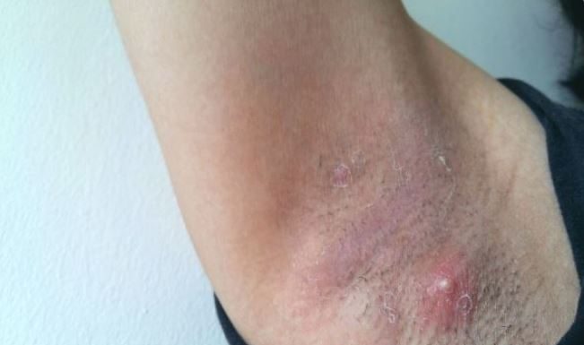 LJUDI SE NE PERU ISPOD PAZUHA KAKO TREBA: Stručnjak za higijenu savetuje čime da izlečite bubuljice i uklonite znoj