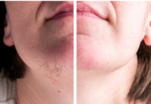 Prirodna Maska Koja Zauvijek Uklanja Neželjene Dlake s Lica