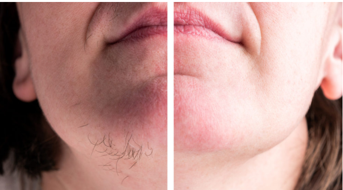 Prirodna Maska Koja Zauvijek Uklanja Neželjene Dlake s Lica