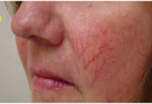 Prisutnost paučastih vena na licu služi kao ključni pokazatelj, signalizirajući mogućnost nadolazeće bolesti