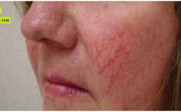 Prisutnost paučastih vena na licu služi kao ključni pokazatelj, signalizirajući mogućnost nadolazeće bolesti