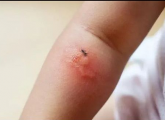 OPASAN INSEKT HARA SRBIJOM: Poznati novinar proživio KATASTROFU nakon ujeda BUBE