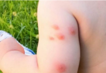 KOMARCI VAM PRAVE PAKAO OD ŽIVOTA? Samo isijecite OVO VOĆE na pola i ostavite u sobi, VIŠE IH NIKADA NEĆETE VIDJETI BLIZU!