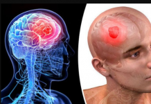 Neurolog OTKRIO koji se simptomi mogu javiti danima prije moždanog udara