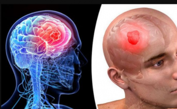 Neurolog OTKRIO koji se simptomi mogu javiti danima prije moždanog udara