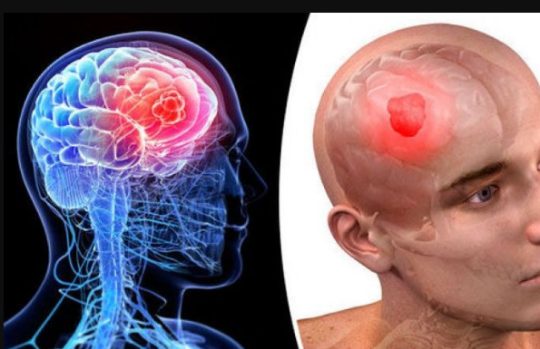 Neurolog OTKRIO koji se simptomi mogu javiti danima prije moždanog udara