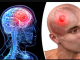 Neurolog OTKRIO koji se simptomi mogu javiti danima prije moždanog udara