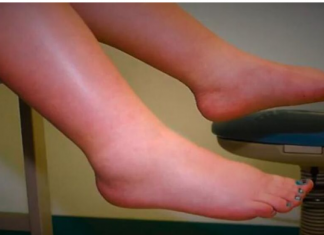 NUTRICIONISTA OTKRIVA ŠTA DA RADITE AKO VAŠE TIJELO ZADRŽAVA VODU: Sve što vam treba imate u kuhinji samo uzmite i…