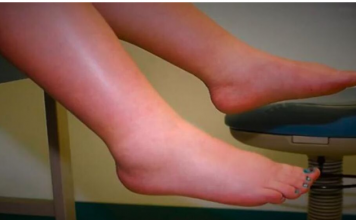 NUTRICIONISTA OTKRIVA ŠTA DA RADITE AKO VAŠE TIJELO ZADRŽAVA VODU: Sve što vam treba imate u kuhinji samo uzmite i…