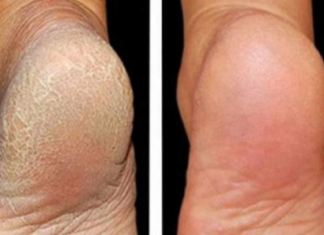 Zaboravite na ispucale pete, kurje oko i gljivice na nogama: Jeftina namirnica je pravi spas