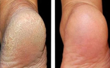 Zaboravite na ispucale pete, kurje oko i gljivice na nogama: Jeftina namirnica je pravi spas