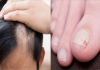 Opadanje kose i pucanje noktiju znak su ozbiljnog poremećaja hormona