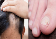 Opadanje kose i pucanje noktiju znak su ozbiljnog poremećaja hormona