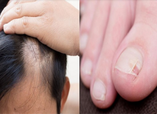 Opadanje kose i pucanje noktiju znak su ozbiljnog poremećaja hormona