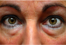 SVE STE PROBALI, ALI SU PODOČNJACI I DALJE TU? Probajte masku od SODE BIKARBONE, CRNOG ČAJA, ili ovih namirnica!