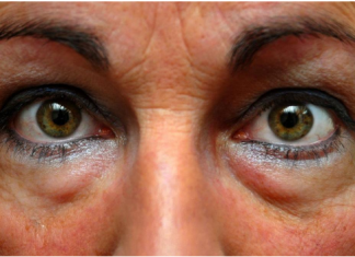 SVE STE PROBALI, ALI SU PODOČNJACI I DALJE TU? Probajte masku od SODE BIKARBONE, CRNOG ČAJA, ili ovih namirnica!