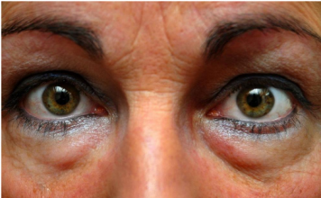 SVE STE PROBALI, ALI SU PODOČNJACI I DALJE TU? Probajte masku od SODE BIKARBONE, CRNOG ČAJA, ili ovih namirnica!