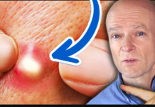 Doktor upozorava: Ovo je 10 JASNIH znakova da jedete previše šećera. Malo ko će ih primijetiti!