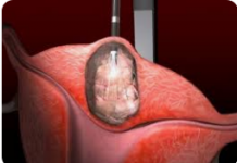 Šta je miom na mateici i zašto puca: Evo kada žena hitno mora da se javi ljekaru