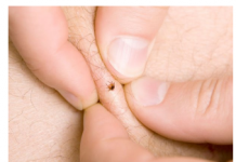 KAKO UKLONITI KRPELJA POMOĆU OBIČNE SOLI: Poslije ovog, krpelj odmah sam izađe na površinu kože!