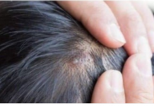 BUBULJICE NA GLAVI SU SVE ČEŠĆI PROBLEM: Ni slučajno ih ne istiskujte, evo zašto se javljaju I ŠTA TREBATE URADITI DA NESTANU