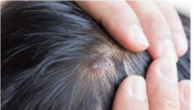 BUBULJICE NA GLAVI SU SVE ČEŠĆI PROBLEM: Ni slučajno ih ne istiskujte, evo zašto se javljaju I ŠTA TREBATE URADITI DA NESTANU