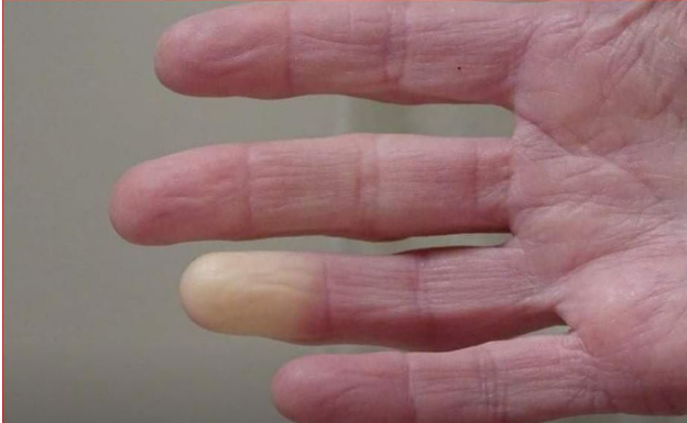 4 razloga zašto imate hladne ruke i stopala: To je simptom, evo šta se dešava u vašem telu