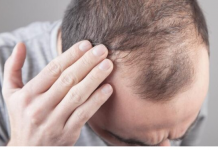 Muči vas opadanje kose? Otkrijte uzroke i prirodna rješenja!