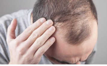 Muči vas opadanje kose? Otkrijte uzroke i prirodna rješenja!