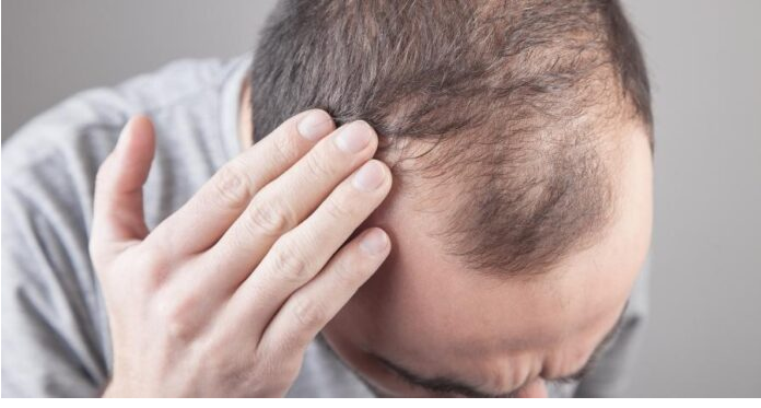 Muči vas opadanje kose? Otkrijte uzroke i prirodna rješenja!