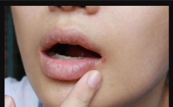 KAKO PREPOZNATI KOJI VAM VITAMIN NEDOSTAJE U TIJELU: Samo obratite pažnju na ove ZNAKOVE