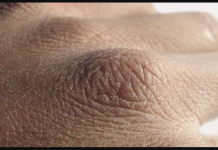 Potcijenio je svoju suhu kožu i ubrzo je završio u bolnici: MALO LJUDI TO ZNA, ali suva koža je znak da postoji problem u ovom organu