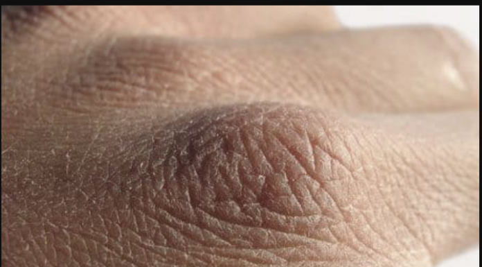 Potcijenio je svoju suhu kožu i ubrzo je završio u bolnici: MALO LJUDI TO ZNA, ali suva koža je znak da postoji problem u ovom organu