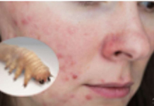 Liječnik je dermoskopom pregledao njezino lice i otkrio da joj KOŽU OŠTEĆUJE PARAZIT – 0prez, stanje koje se vrlo lako širi