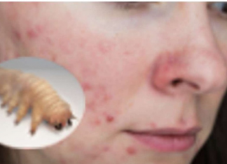 Liječnik je dermoskopom pregledao njezino lice i otkrio da joj KOŽU OŠTEĆUJE PARAZIT – 0prez, stanje koje se vrlo lako širi