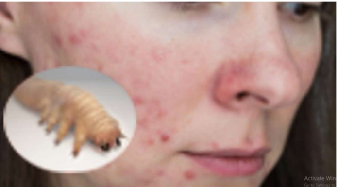 Liječnik je dermoskopom pregledao njezino lice i otkrio da joj KOŽU OŠTEĆUJE PARAZIT – 0prez, stanje koje se vrlo lako širi