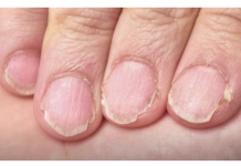 MUČE VAS UMOR, TANKA KOSA I LOMLJIVI NOKTI, EVO ŠTA VAM NEDOSTAJE U ISHRANI