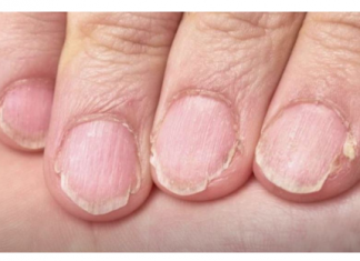 MUČE VAS UMOR, TANKA KOSA I LOMLJIVI NOKTI, EVO ŠTA VAM NEDOSTAJE U ISHRANI