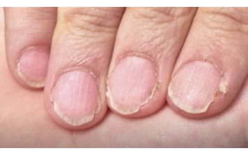 MUČE VAS UMOR, TANKA KOSA I LOMLJIVI NOKTI, EVO ŠTA VAM NEDOSTAJE U ISHRANI