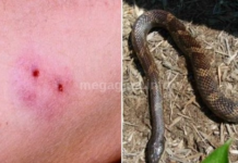 Evo šta prvo da uradite ako vas ujede zmija: Led nikako ne stavljajte na NA BOLNO MJESTO