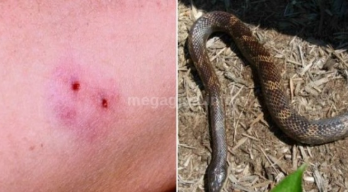 Evo šta prvo da uradite ako vas ujede zmija: Led nikako ne stavljajte na NA BOLNO MJESTO