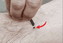 Evo kako pravilno ukloniti krpelja i šta nikada ne smijete raditi prilikom uklanjanja!